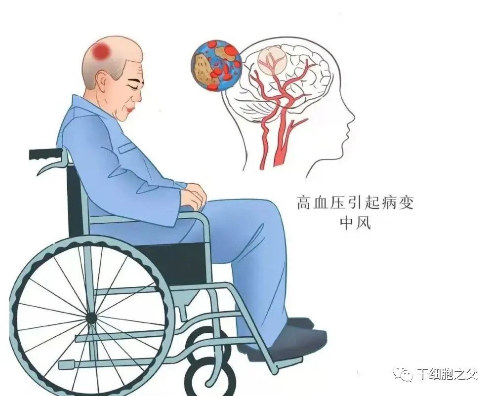 2项临床研究表明：干细胞治疗脑出血安全有效，潜力巨大！(图1)