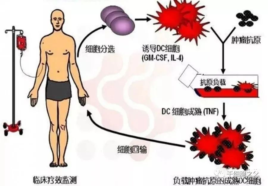 挑战癌王！诺奖(jiǎng)得(de)主斯(sī)坦(tǎn)曼(màn)“以(yǐ)身(shēn)试(shì)药(yào)”，树(shù)突(tū)状(zhuàng)细(xì)胞(bāo)疗(liáo)法(fǎ)将(jiāng)他(tā)生(shēng)存(cún)期(qī)延(yán)长(zhǎng)4年(nián)半(bàn)(图(tú)4)